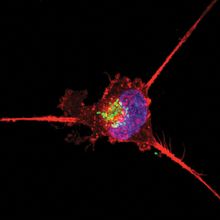 A photo of a triple-negative breast cancer cell