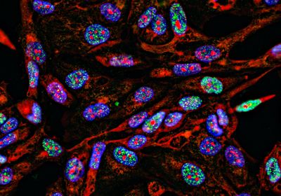 Immunofluorescence light microscopy image of cancer cells growing in 2D with nuclei in blue, cytoplasm in red, and DNA damage foci in green.