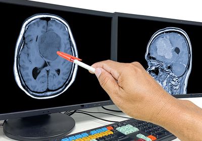 Brain tumor on an MRI scan