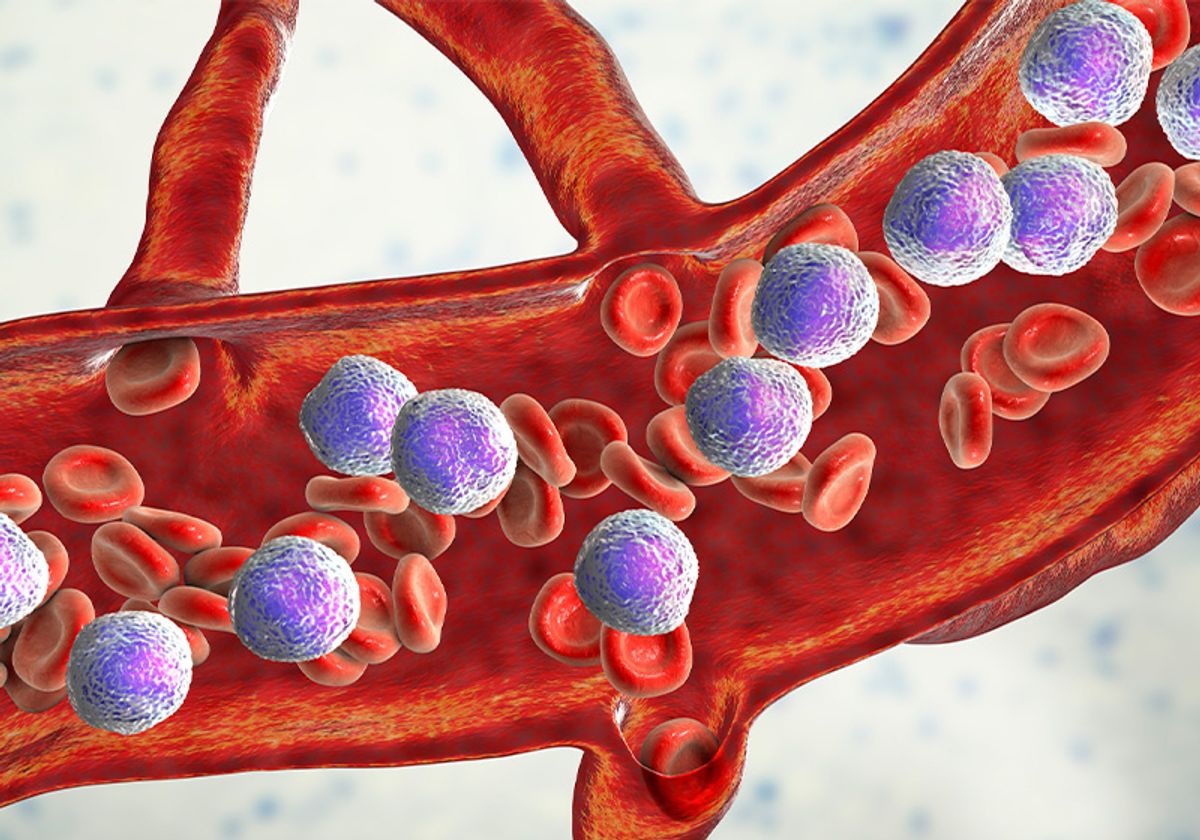 3D medical illustration showing acute lymphoblastic leukemia cells and red blood cells in circulation.