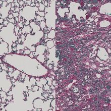 Histology of mouse lungs using purple and green staining on a white background. Left: a healthy lung. Right: a fibrotic lung.<br><br>
