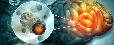 Medical illustration of brain cancer with a microscopic magnification of malignant cells dividing in the tumor microenvironment.