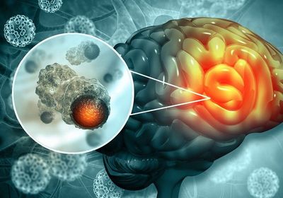 Medical illustration of brain cancer with a microscopic magnification of malignant cells dividing in the tumor microenvironment.